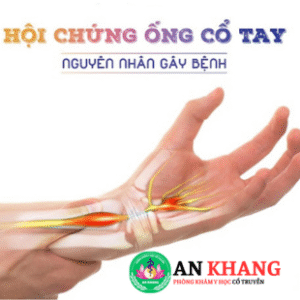Hội chứng ống cổ tay